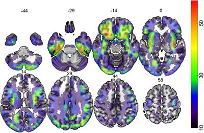 A Role for the Action Observation Network in Apraxia After Stroke